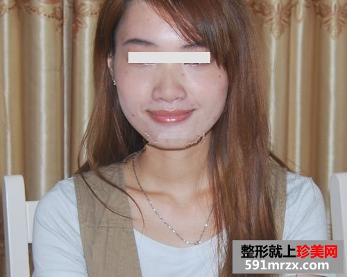 眼袋去除后，眼睛变得炯炯有神了