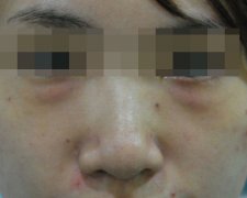 眼袋去除后，眼睛变得炯炯有神了