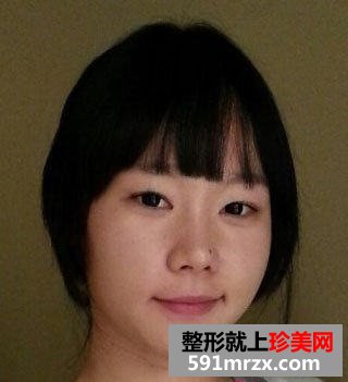 眼袋去除手术之后，“小金鱼”称号不再属于我