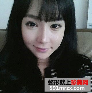 眼袋去除手术之后，“小金鱼”称号不再属于我