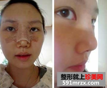 玻尿酸隆鼻头，和难看的猪鼻子说再见