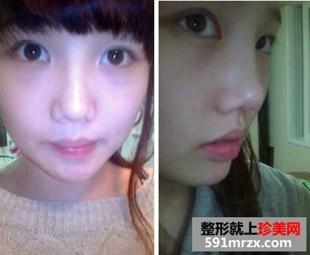 玻尿酸隆鼻头，和难看的猪鼻子说再见