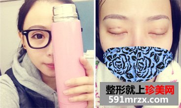 做了生物焊接双眼皮手术，素颜也是美美哒