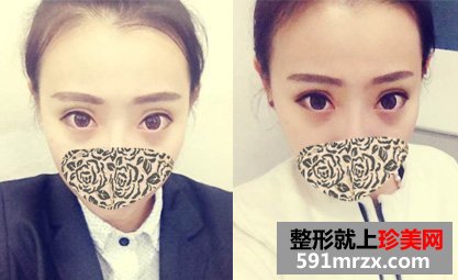 做了生物焊接双眼皮手术，素颜也是美美哒