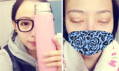 做了生物焊接双眼皮手术，素颜也是美美哒