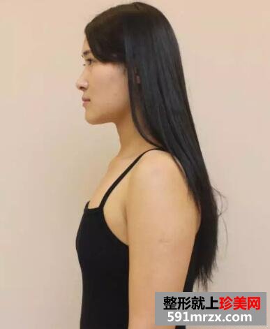 郑州90后瑜伽老师无痕丰胸手术一周后做了什么