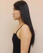 郑州90后瑜伽老师无痕丰胸手术一周后变化竟如此之大？