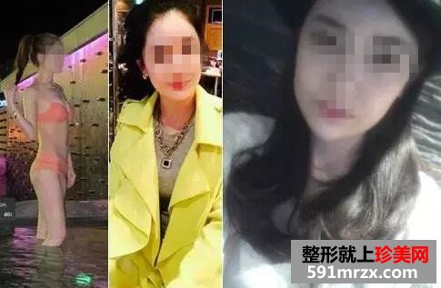 水滴型假体隆胸 一次增大2个罩杯