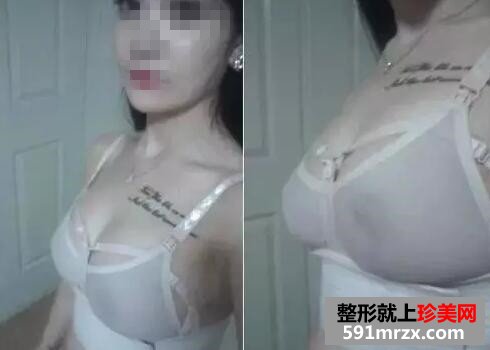 水滴型假体隆胸 一次增大2个罩杯
