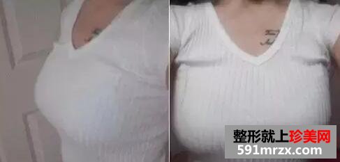 水滴型假体隆胸 一次增大2个罩杯