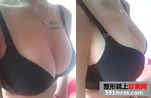 水滴型假体隆胸 一次增大2个罩杯