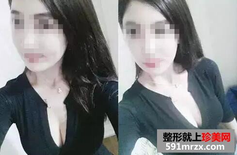 水滴型假体隆胸 一次增大2个罩杯