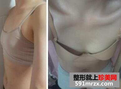 26岁天生胸平做了20°少女CC美胸术后变这样了