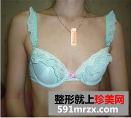 玲玲分享做娜高假体丰胸的真实经历：放心吧，一点也不疼
