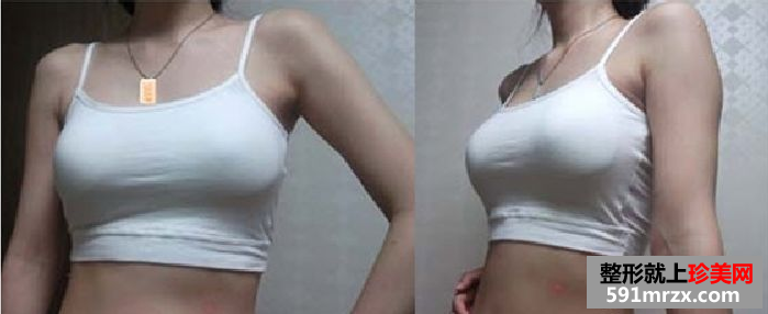 玲玲分享做娜高假体丰胸的真实经历：放心吧，一点也不疼