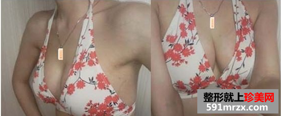 玲玲分享做娜高假体丰胸的真实经历：放心吧，一点也不疼