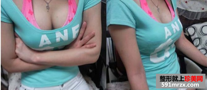 玲玲分享做娜高假体丰胸的真实经历：放心吧，一点也不疼