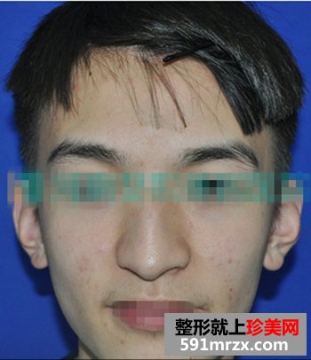塌鼻子隆鼻前后对比照片 男人也爱美