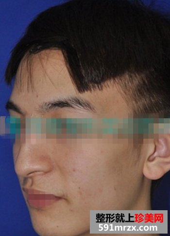 塌鼻子隆鼻前后对比照片 男人也爱美