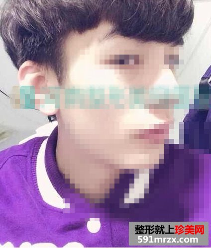 塌鼻子隆鼻前后对比照片 男人也爱美