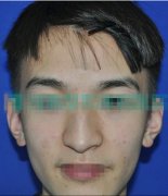 男士塌鼻子隆鼻前后对比照片分享