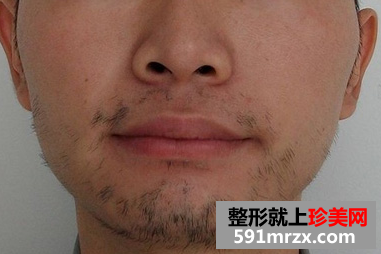 激光脱胡子 轻松甩掉大叔形象