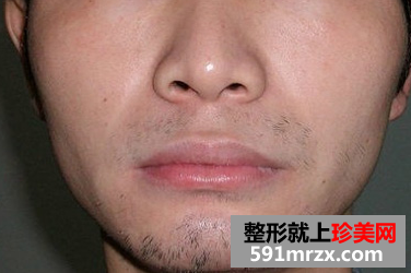 激光脱胡子 轻松甩掉大叔形象