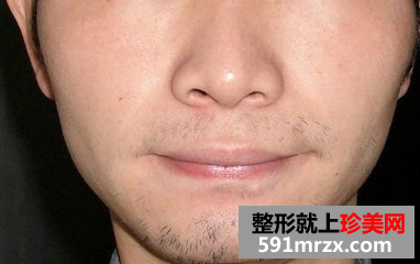 激光脱胡子 轻松甩掉大叔形象
