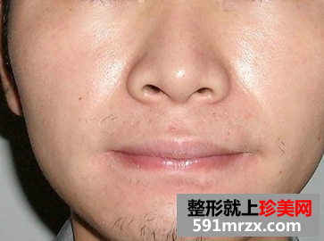 激光脱胡子 轻松甩掉大叔形象