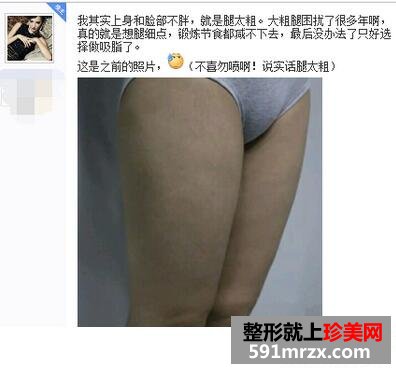 做了大腿吸脂手术 三个月瘦了八公分
