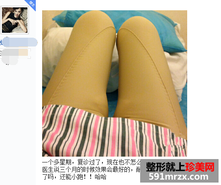 做了大腿吸脂手术 三个月瘦了八公分