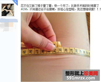 做了大腿吸脂手术 三个月瘦了八公分