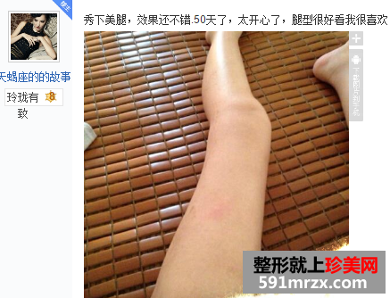 做了大腿吸脂手术 三个月瘦了八公分