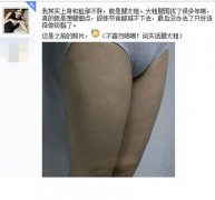 做了大腿吸脂手术瘦了很多