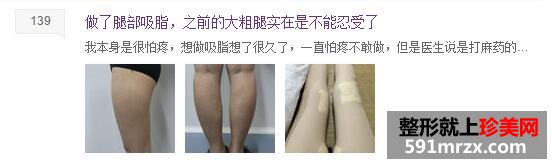 大腿部吸脂减肥 露出你的纤细长白腿