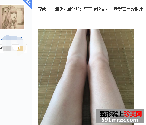 大腿部吸脂减肥 露出你的纤细长白腿