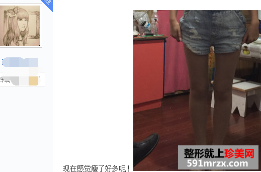 大腿部吸脂减肥 露出你的纤细长白腿