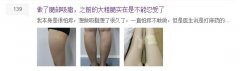 大腿部吸脂减肥露出你的纤细长白腿