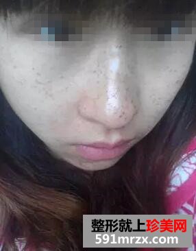 复合彩光祛斑9天 终于不是＂小麻雀＂啦
