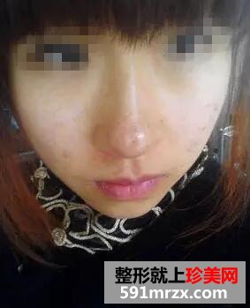 复合彩光祛斑9天 终于不是＂小麻雀＂啦