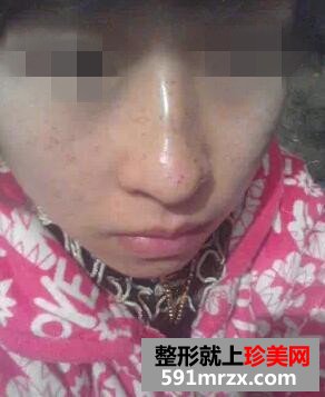 复合彩光祛斑9天 终于不是＂小麻雀＂啦