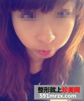复合彩光祛斑9天 终于不是＂小麻雀＂啦