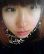 复合彩光祛斑9天后效果不错哦