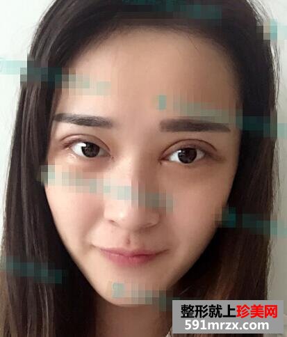 小清新双眼皮术后护理知识分享