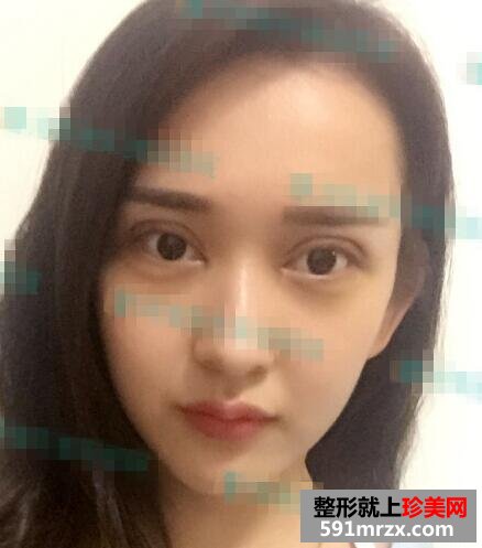 小清新双眼皮术后护理知识分享