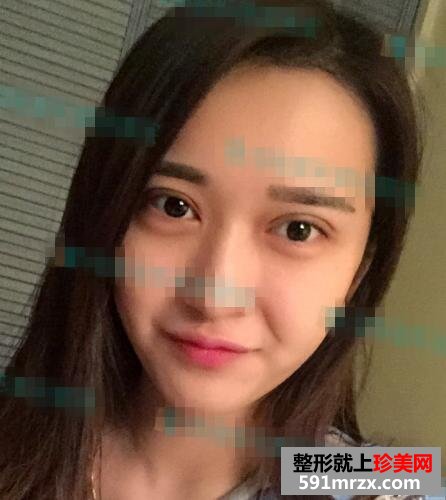 小清新双眼皮术后护理知识分享