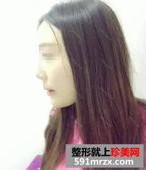 自体耳软骨隆鼻+膨体垫下巴 男票喜欢和我逛街了
