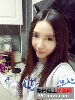自体耳软骨隆鼻+膨体垫下巴 男票喜欢和我逛街了