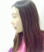 自体耳软骨隆鼻+膨体垫下巴男票经常都带上我