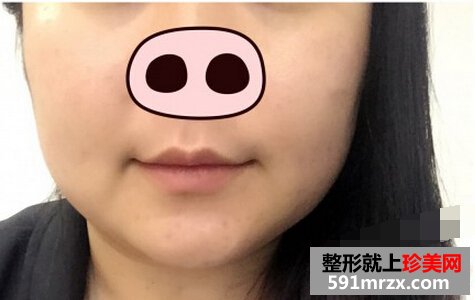 第一次打瘦脸针 效果还是很满意的